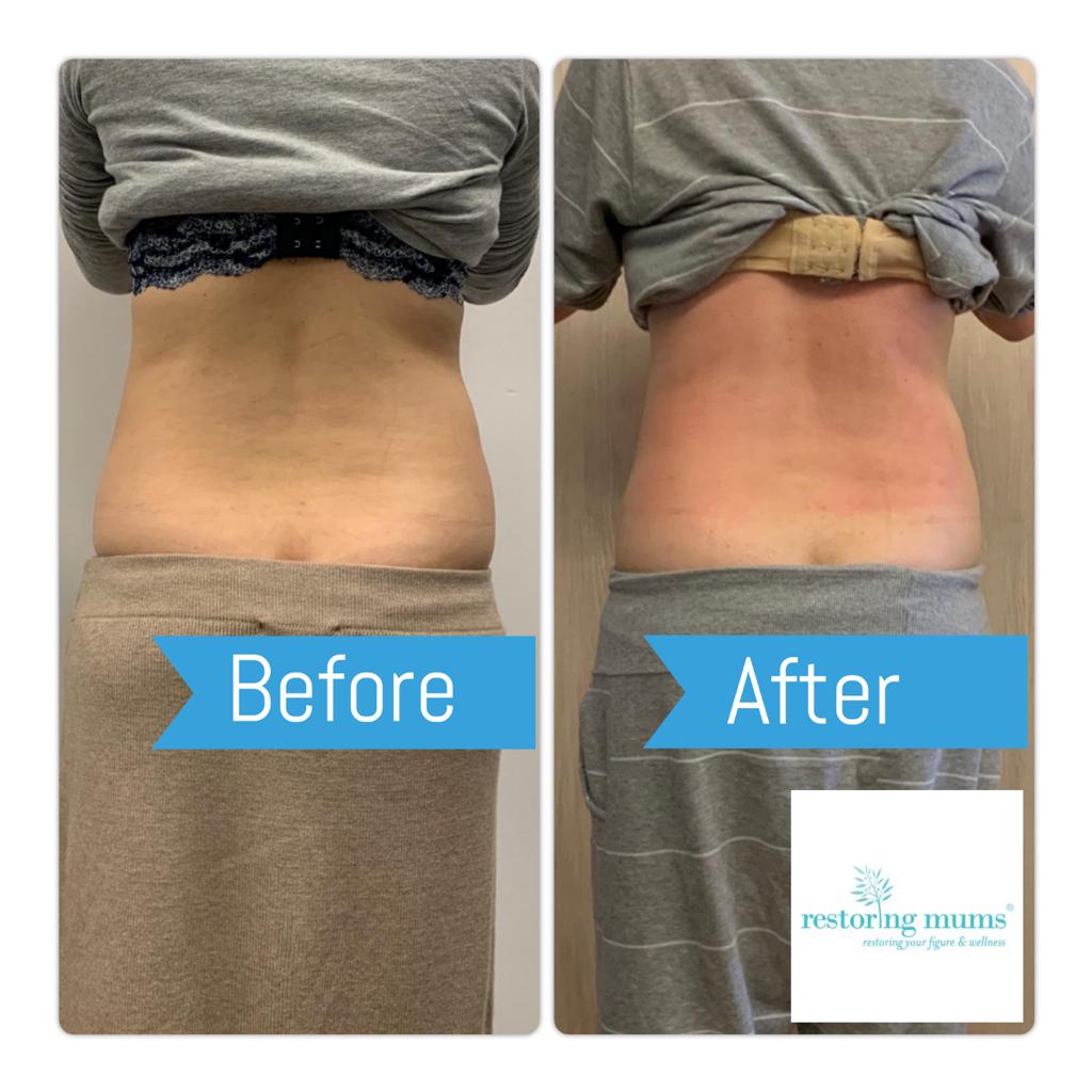 這是我上年紮肚前後對比照，講真相比其他媽媽，我沒有很dramatic的效果，畢竟每個人的體質不同，不過身體整體感覺好多了，尤其手腳冰冷和宮寒情況。