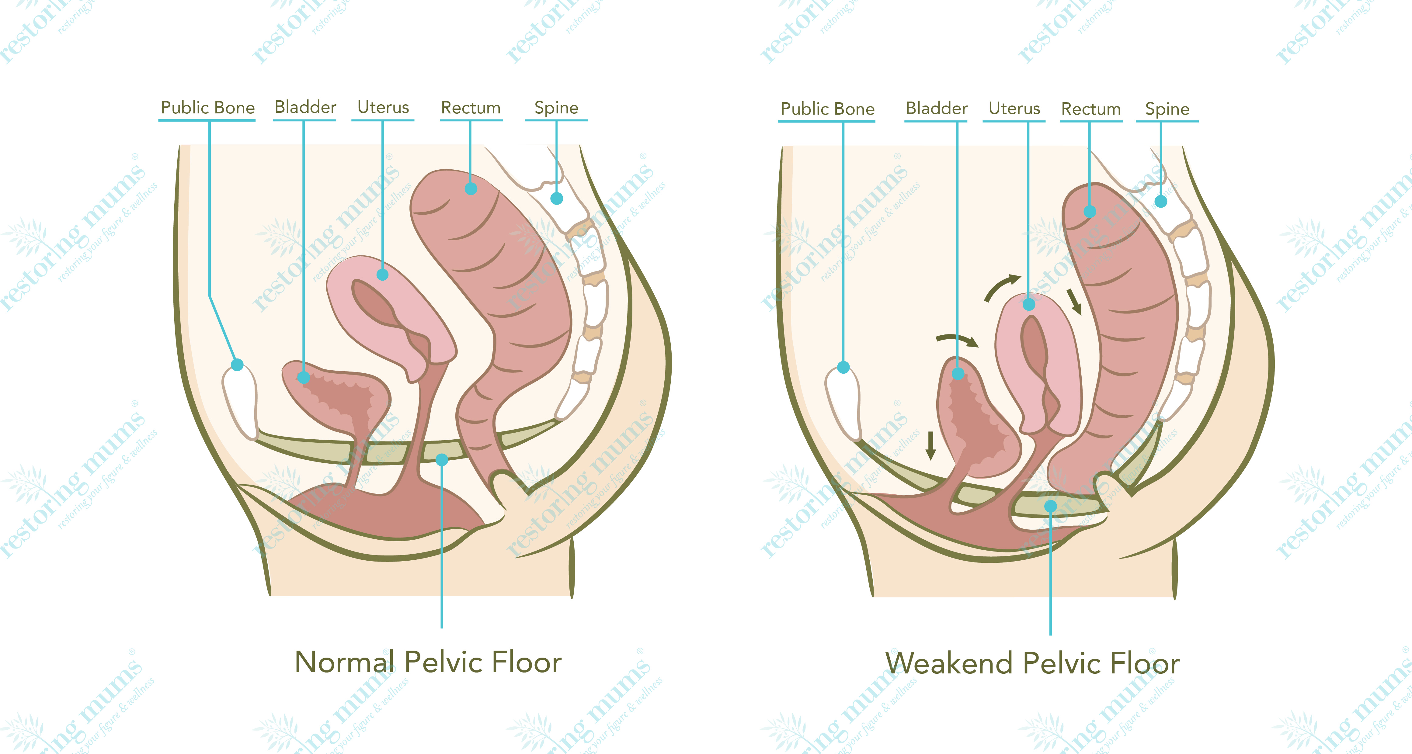 （左）正常的骨盆底，（右）女性在產後膀胱(Bladder)、子宮(uterus)、直腸(rectum)和脊柱(spine)，以至整個骨盆底都出現鬆弛和變形。